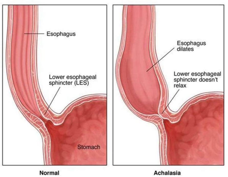 Αχαλασία Οισοφάγου