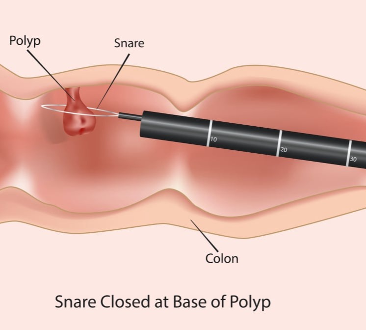 Αφαίρεση πολύποδα