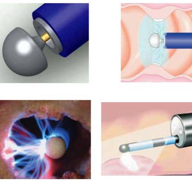 Καυτηρίαση κονδυλωμάτων με APC