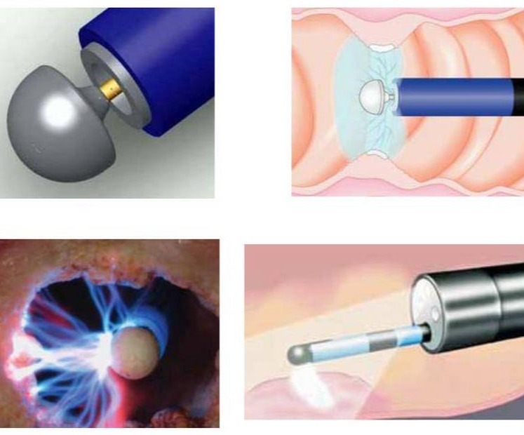 Διαθερμοπηξία (καυτηριασμός) κονδυλωμάτων πρωκτού με argon (APC)