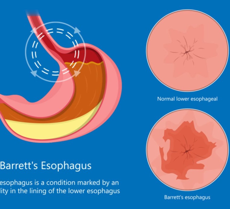 Οισοφάγος Μπάρρετ (Barrett)