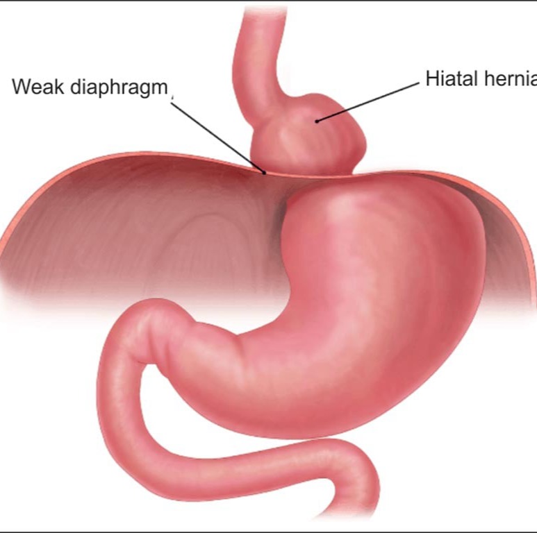Διαφραγματοκήλη