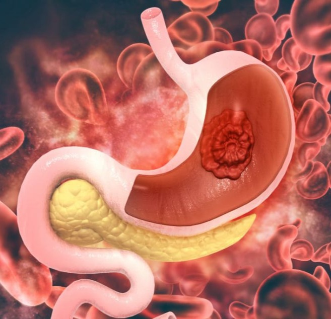 Καρκίνος στομάχου