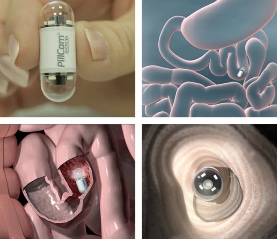 Ενδοσκοπική Κάψουλα για τον έλεγχο λεπτού εντέρου