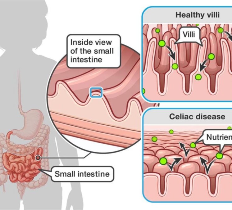 Κοιλιοκάκη
