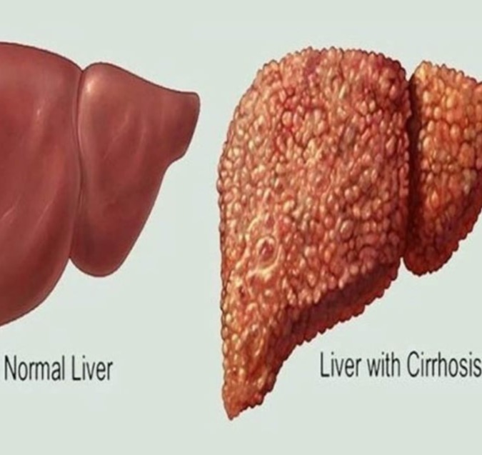 Κίρρωση ήπατος