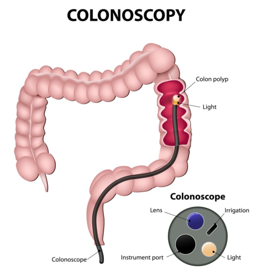 Κολονοσκόπηση