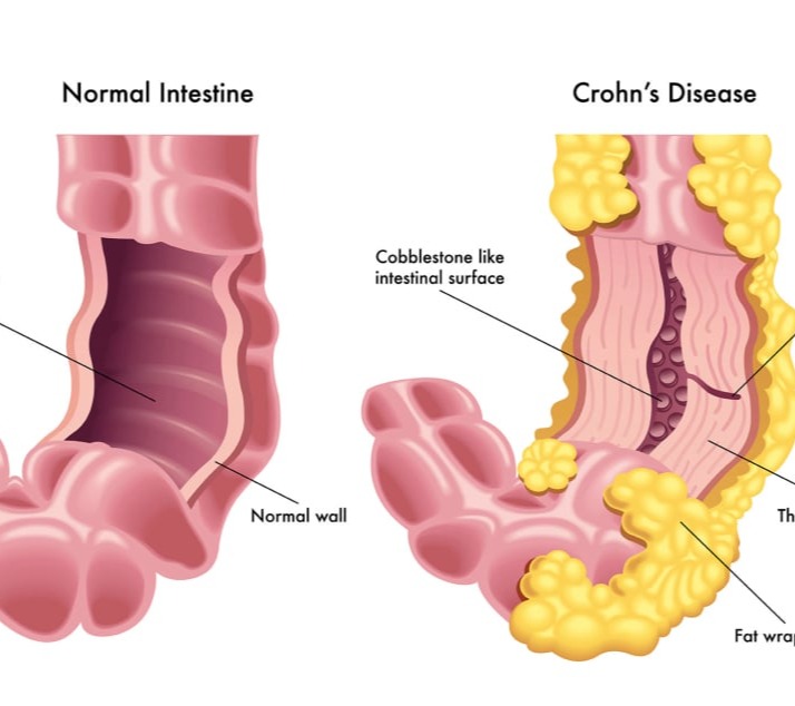 Νόσος του Crohn