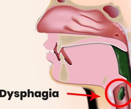 Δυσφαγία