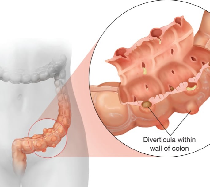 Εκκολπώματα – Εκκολπωματίτιδα