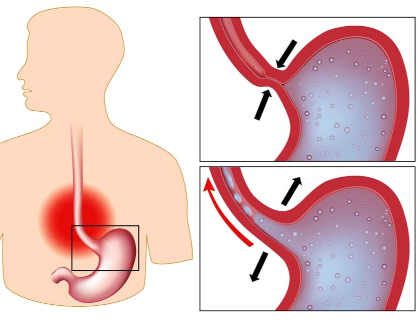 Ηωσινοφιλική οισοφαγίτιδα