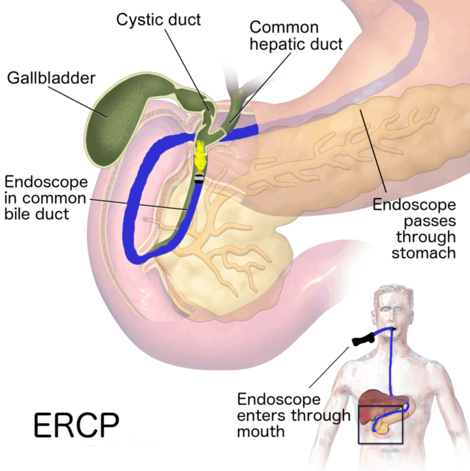 ERCP