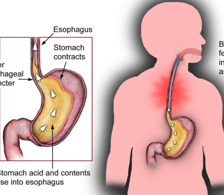 Οισοφαγίτιδα