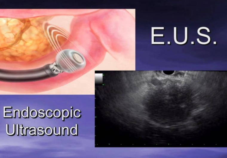 Ενδοσκοπικός υπέρηχος και FNA