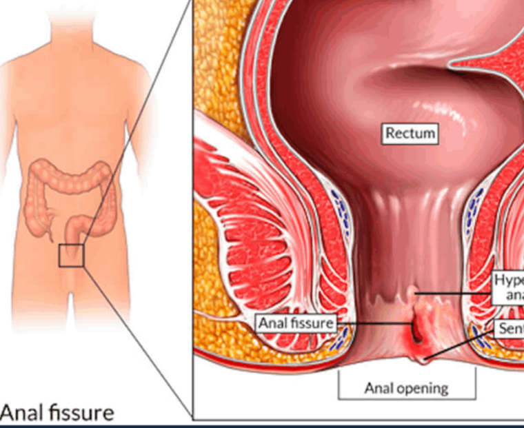 Ραγάδα πρωκτού