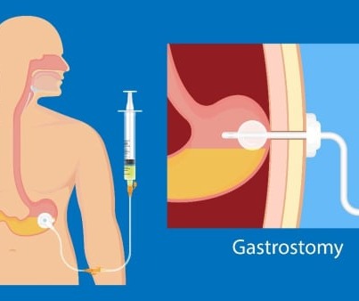 Ενδοσκοπική τοποθέτηση γαστρικού σωλήνα σίτισης – γαστροστομία (PEG)