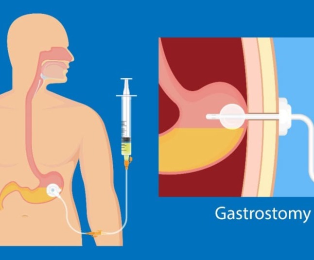 Ενδοσκοπική τοποθέτηση γαστρικού σωλήνα σίτισης - γαστροστομία (PEG)