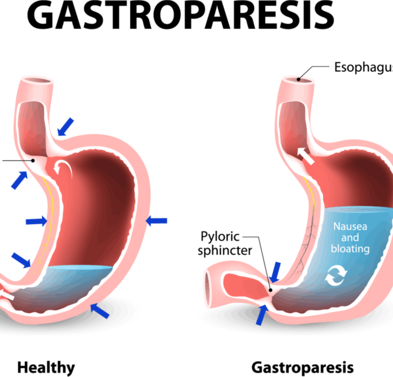 Γαστροπάρεση