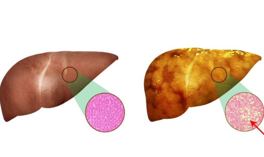 Αιμοχρωμάτωση