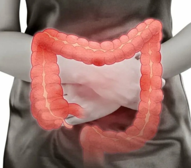 Ελκώδης κολίτιδα