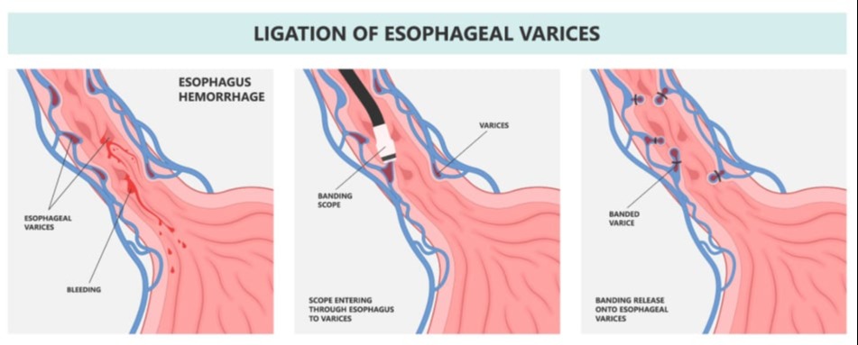 Απολίνωση κιρσών οισοφάγου