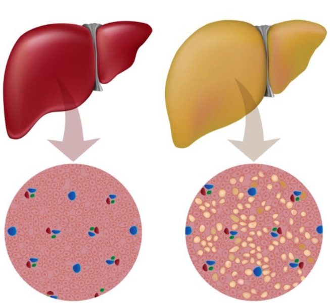 Μη αλκοολική λιπώδης νόσος του ήπατος