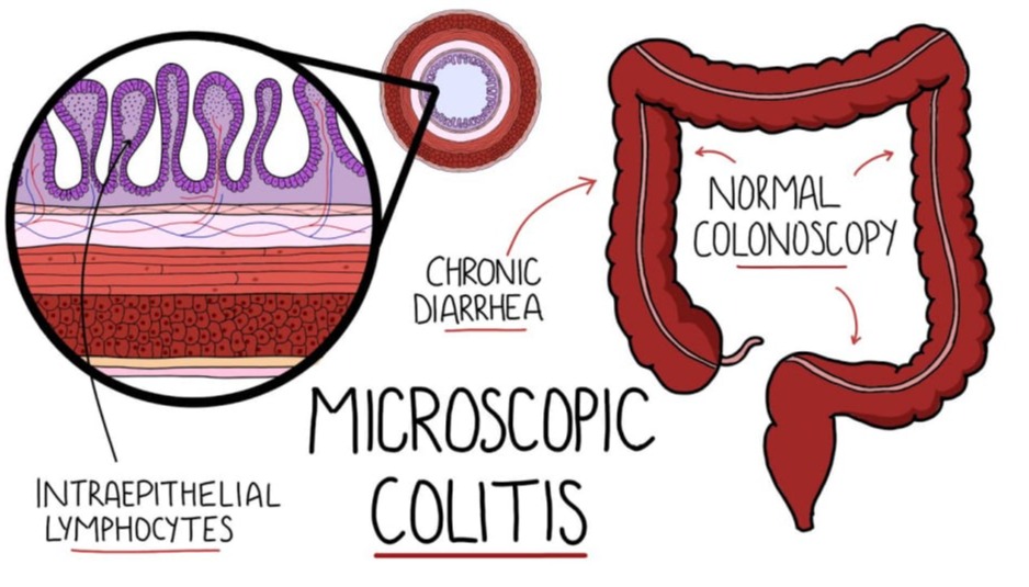 Μικροσκοπική κολίτιδα