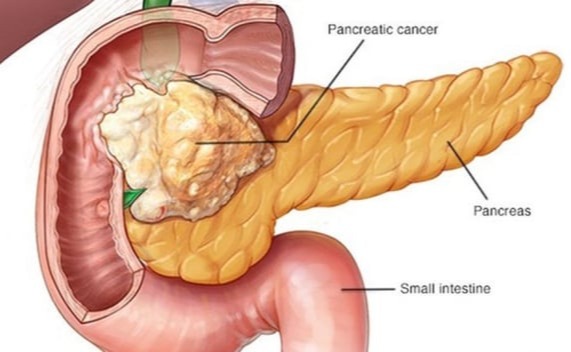 Καρκίνος στο πάγκρεας