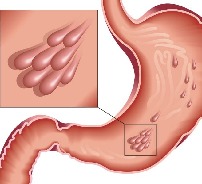 Πολύποδες στομάχου