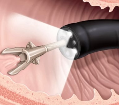 Αφαίρεση Πολύποδων (Πολυπεκτομές)