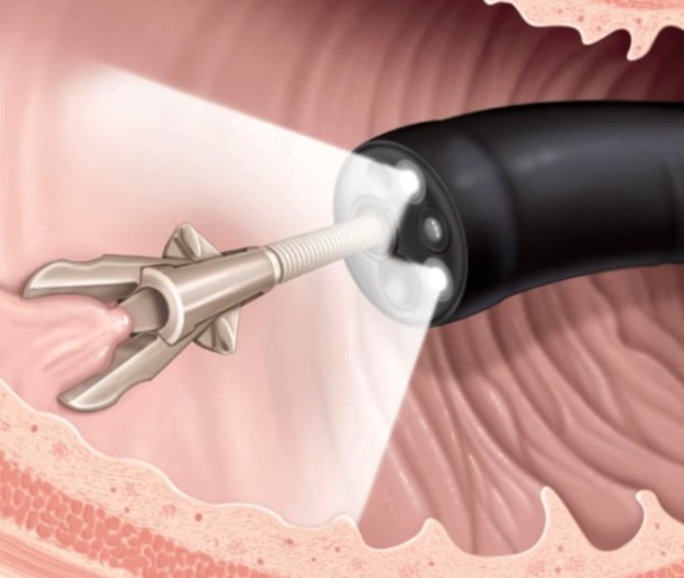 Αφαίρεση Πολύποδων (Πολυπεκτομές)