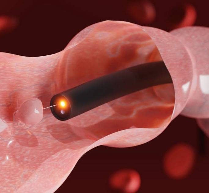 Πολύποδες παχέος εντέρου – Πολυπεκτομή