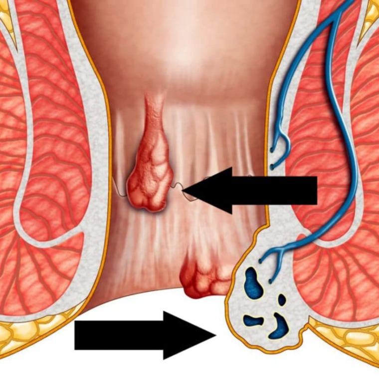 Κονδυλώματα στον πρωκτό