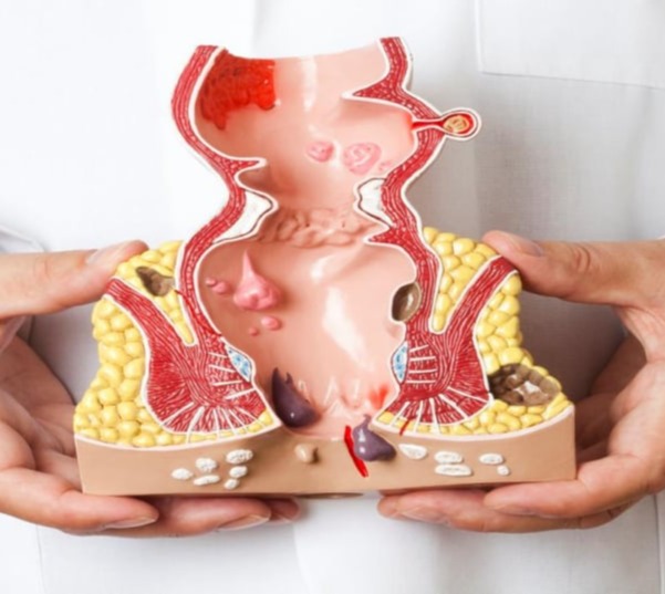 Αιμορροΐδες