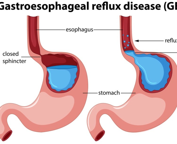 Γαστροοισοφαγική παλινδρόμηση