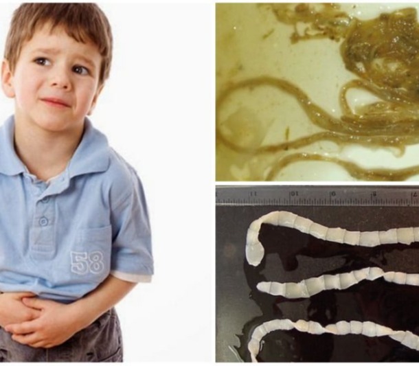 Σκουλήκια στα κόπρανα (Οξυουρίαση)