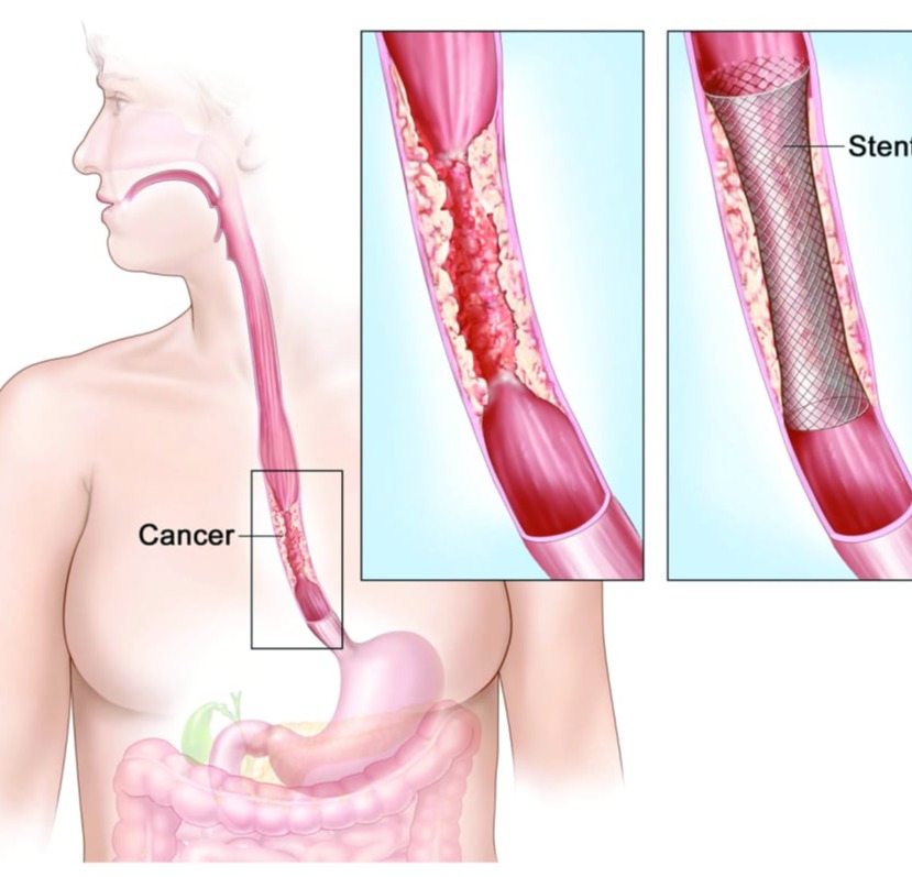 Ενδοσκοπική ΚάψΤοποθέτηση ενδοπρόθεσης stent οισοφάγου - στομάχου - παχέος εντέρουουλα για τον έλεγχο λεπτού εντέρου