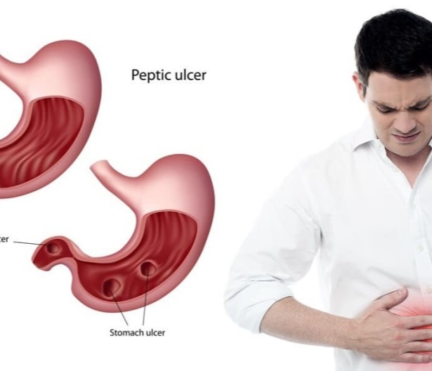 Πεπτικό έλκος (στομάχου – δωδεκαδακτύλου)
