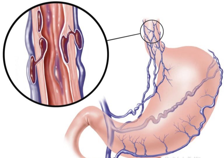Κιρσοί οισοφάγου σε ασθενείς με κίρρωση ήπατος