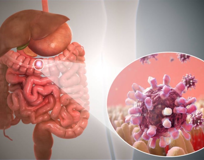 Γαστρεντερίτιδα