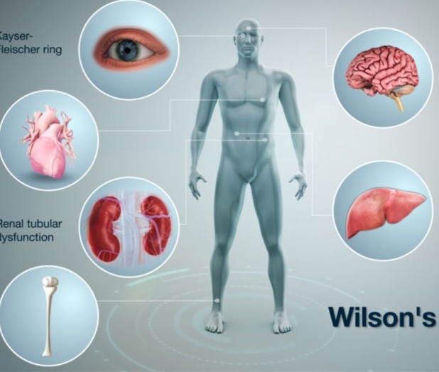 Νόσος του Wilson